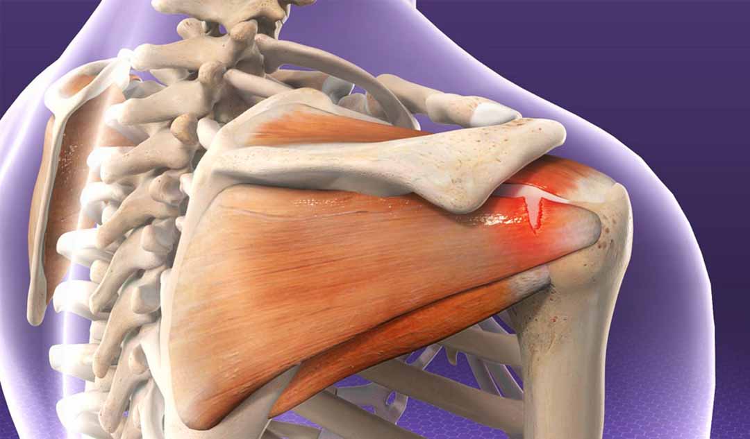 Làm thế nào mà bạn mắc phải hội chứng Rotator cuff?