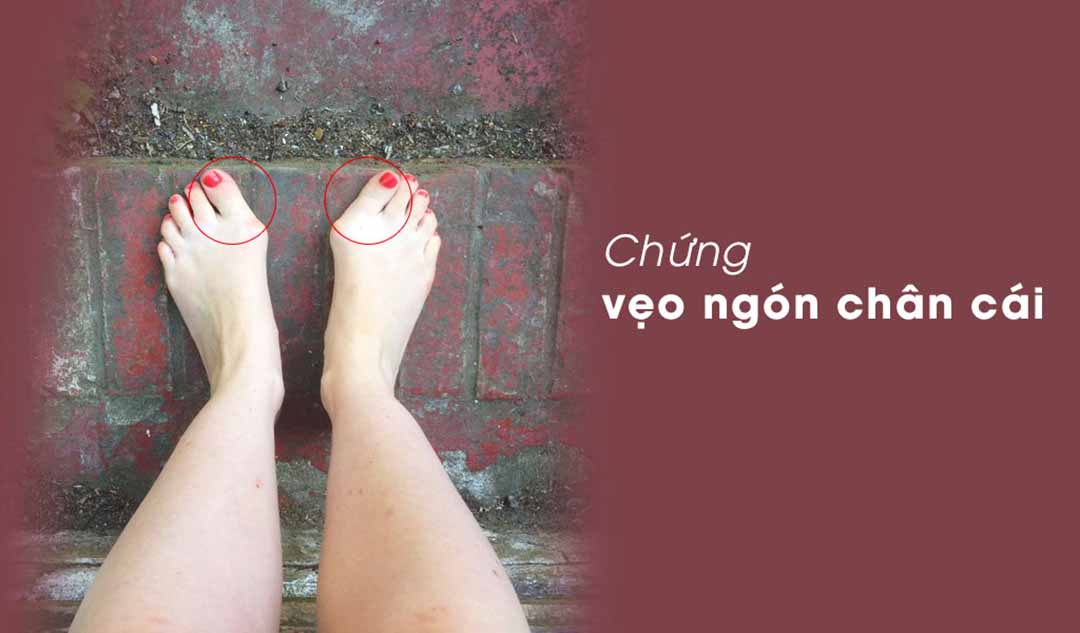 Một số vấn đề có thể xảy ra sau khi phẫu thuật cho chứng vẹo ngón chân cái là gì?