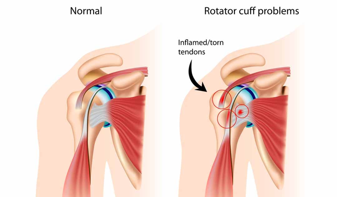 Người mắc phải hội chứng Rotator cuff cảm thấy như thế nào?