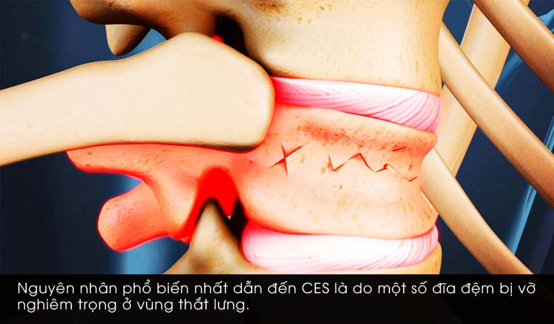 Nguyên nhân của Hội chứng chùm đuôi ngựa (Cauda Equina Syndrome - CES) là gì?