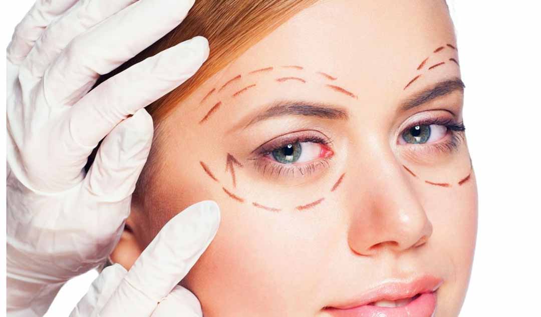 Phẫu thuật mí mắt có được áp dụng bảo hiểm y tế hay không?