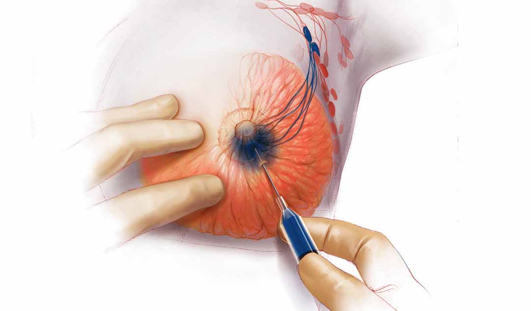 Sinh thiết hạch giữ cửa (sentinel node biopsy) được thực hiện như thế nào?