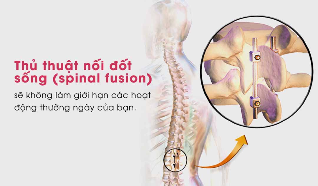 Thủ thuật nối đốt sống (spinal fusion) là gì?