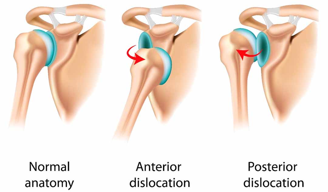 Trật khớp vai là như thế nào?