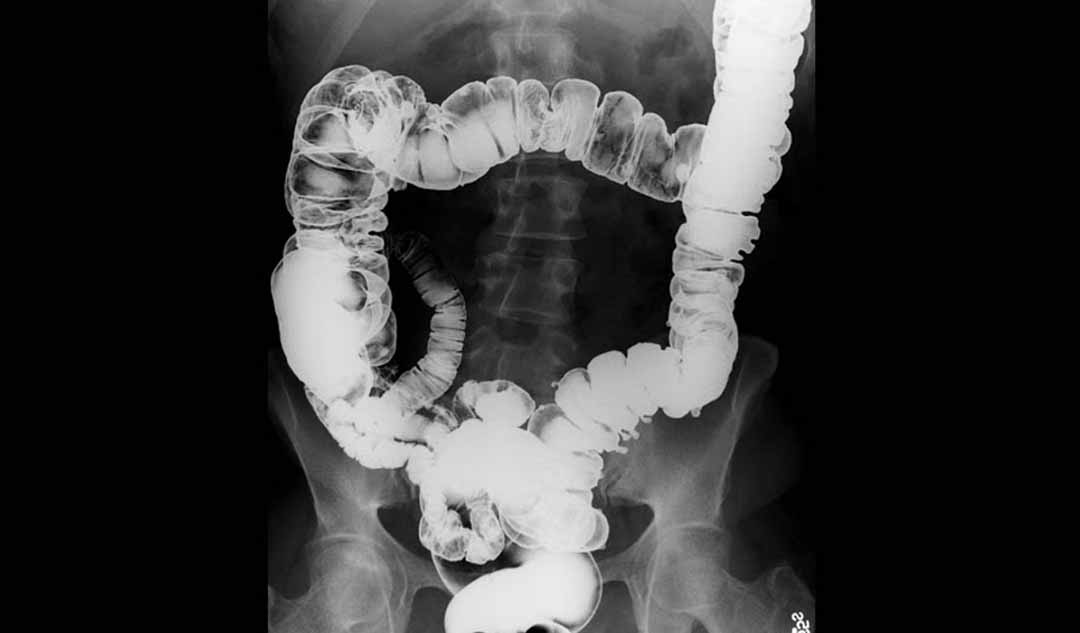 Bệnh Crohn được chẩn đoán như thế nào ? 