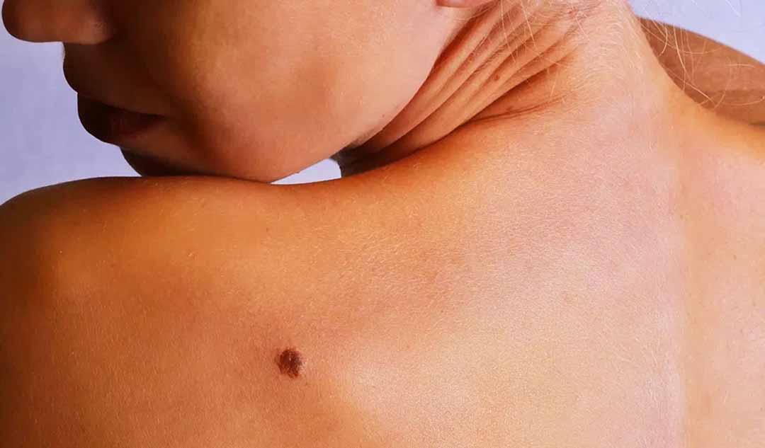 Bệnh viêm ruột ảnh hưởng đến da như thế nào ?