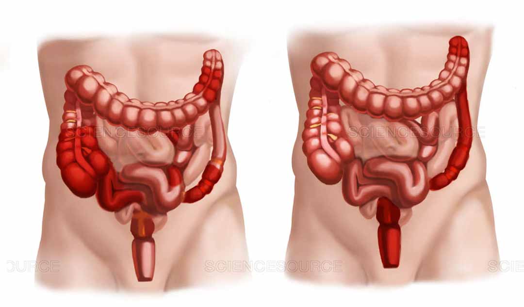 Bệnh viêm ruột gây ra các vấn đề ở những nơi khác trong cơ thể như thế nào?