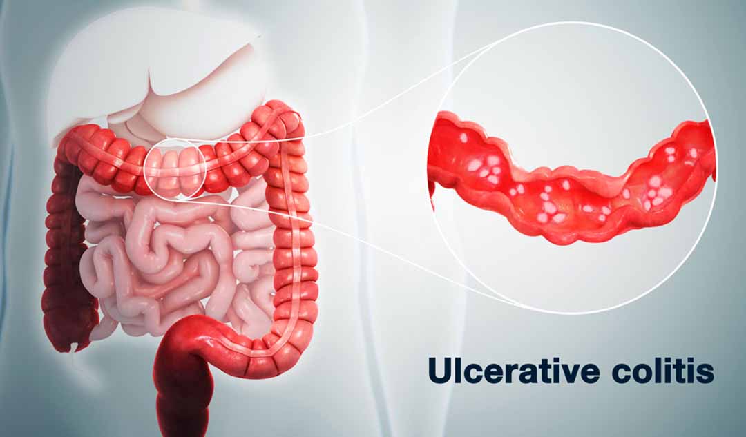 Các triệu chứng nhất định của bệnh Crohn và viêm loét đại tràng (UC - Ulcerative colitis) khác nhau như thế nào?