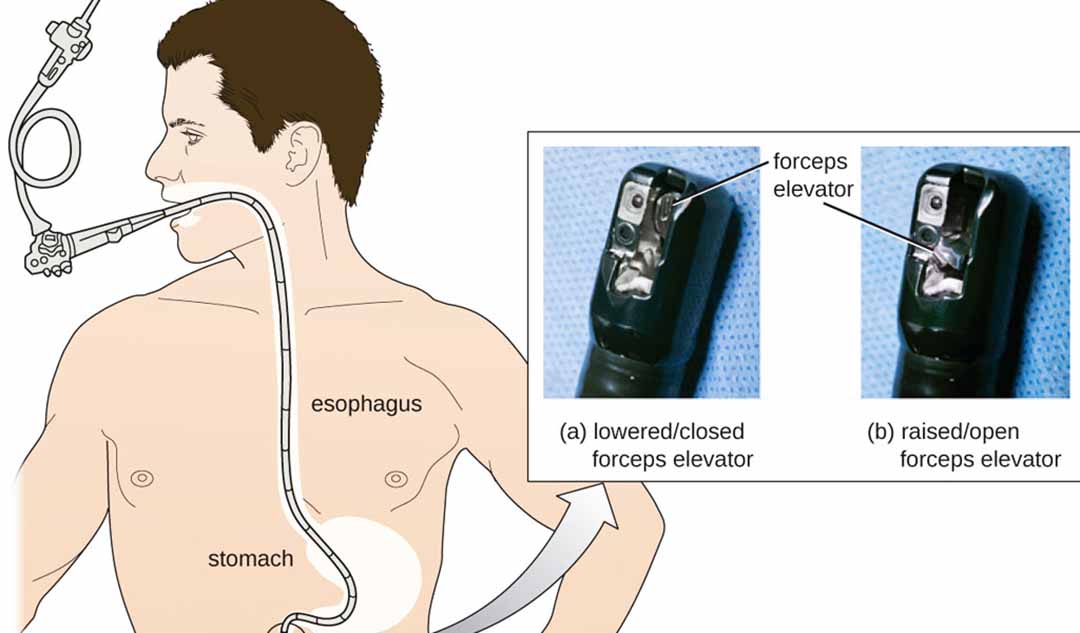 Những loại nội soi đặc trưng được dùng để chẩn đoán bệnh Crohn và viêm loét đại tràng như thế nào?