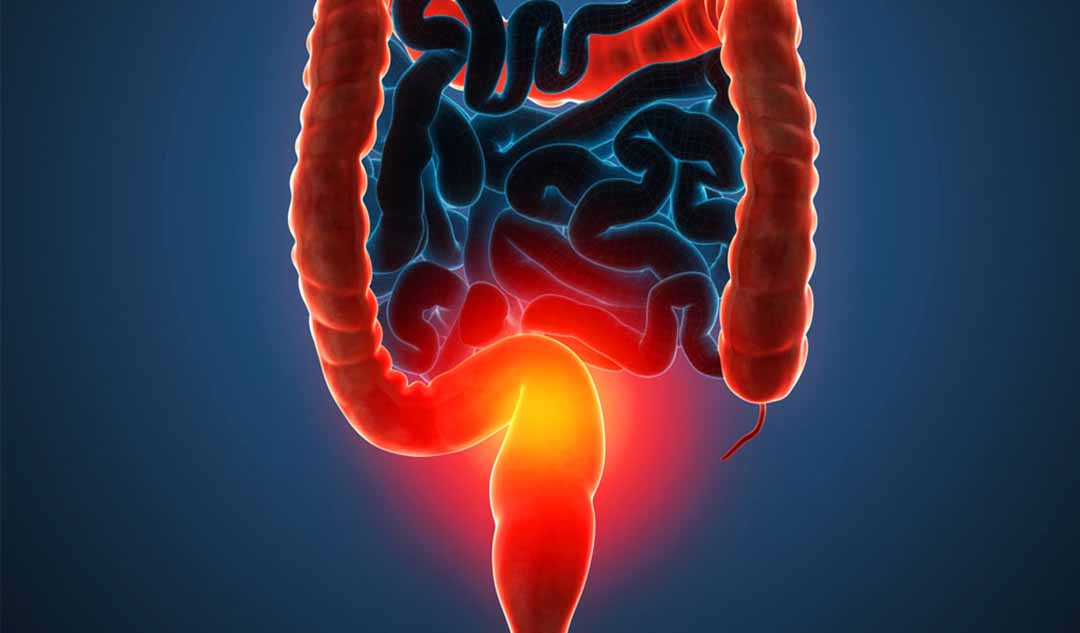 Những loại thuốc nào được dùng để điều trị bệnh Crohn và viêm loét đại tràng (UC - ulcerative colitis) ?