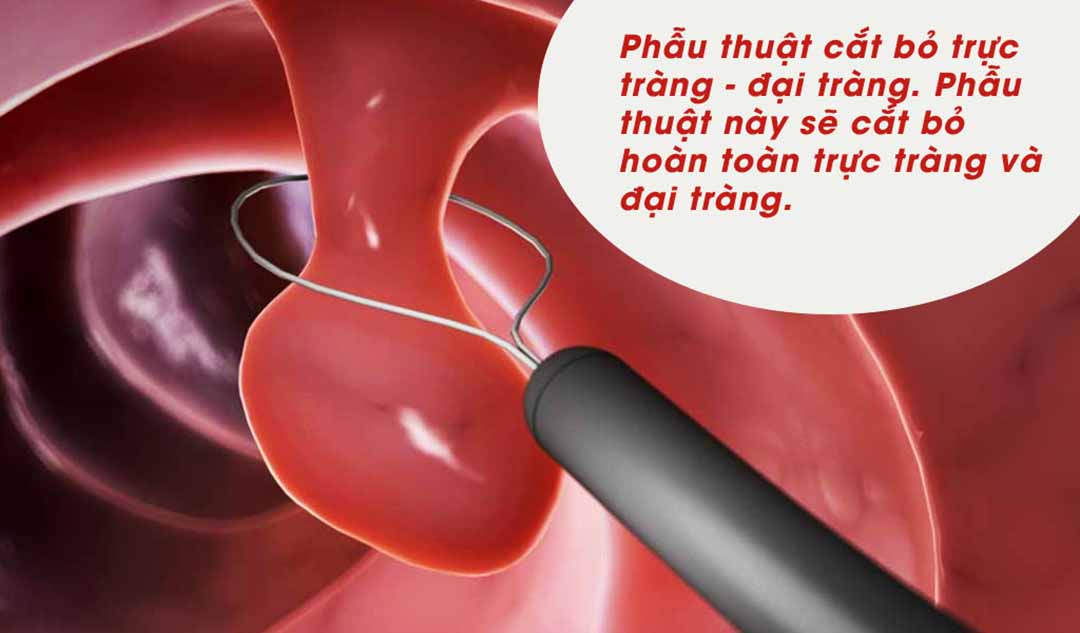 Những lựa chọn phẫu thuật nào có sẵn cho việc điều trị bệnh viêm ruột?