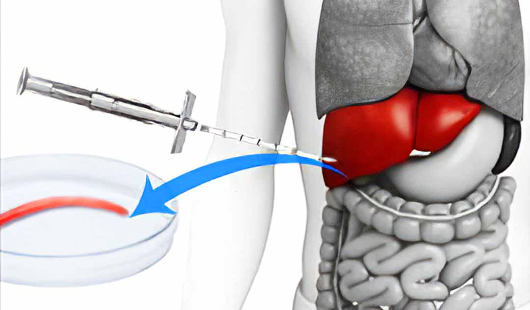 Những xét nghiệm nào tôi có thể cần sau khi được chẩn đoán mắc bệnh viêm gan C?