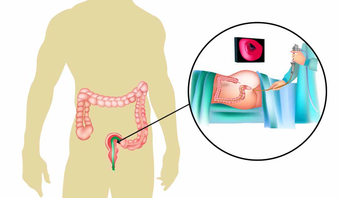 Soi đại tràng sigma được dùng để chẩn đoán bệnh viêm ruột như thế nào?