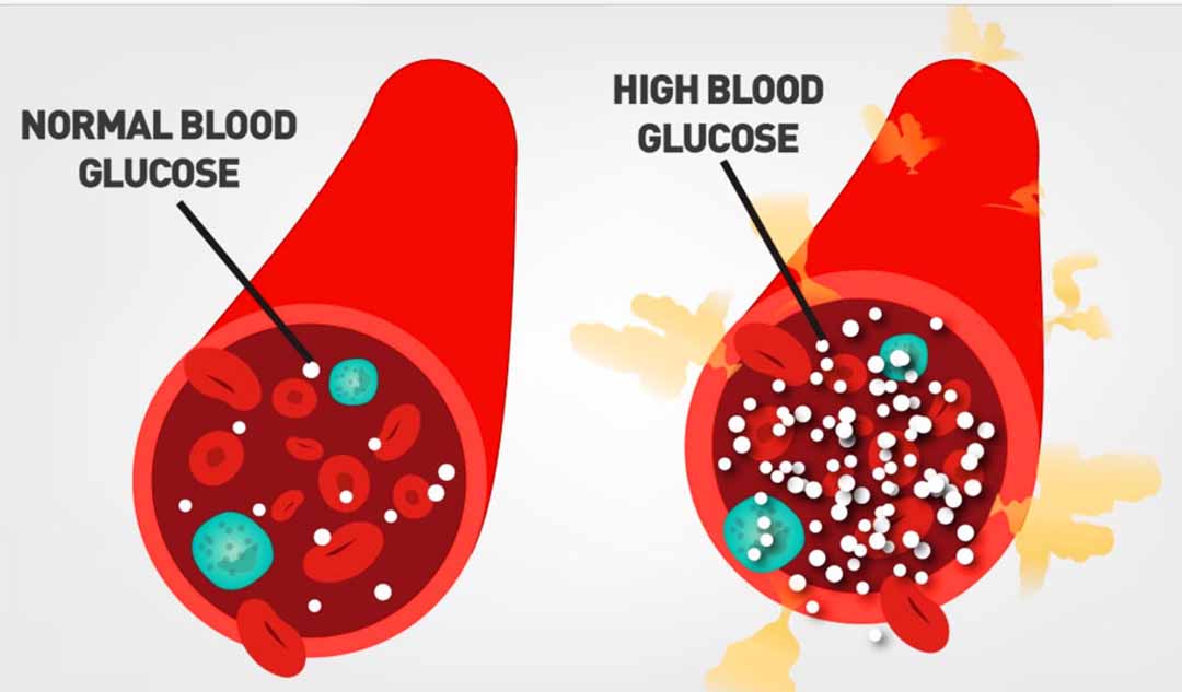 Tại sao khi Viêm gan C không điều trị lại dẫn đến việc lượng đường trong máu tăng cao ?