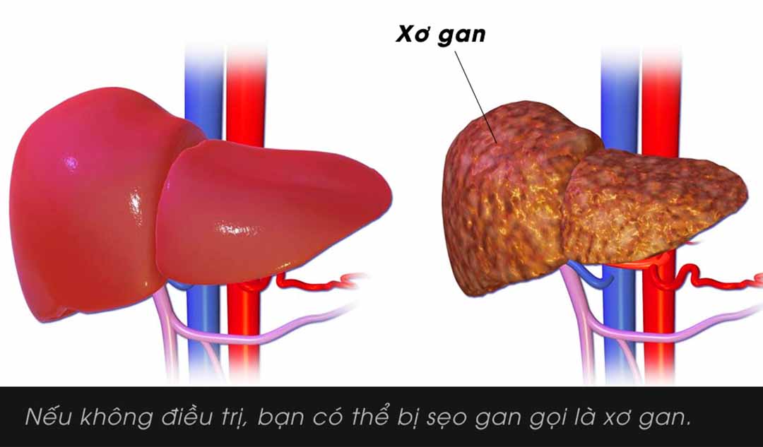 Viêm gan C khi không được điều trị có thể ảnh hưởng đến bạn như thế nào ?