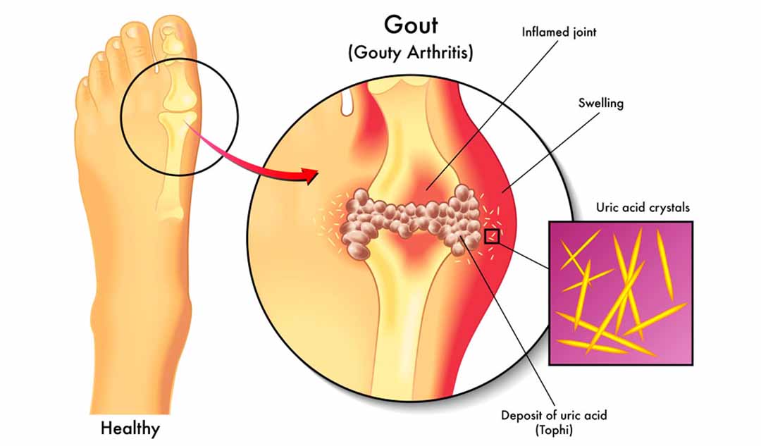 Bệnh gút là gì ?