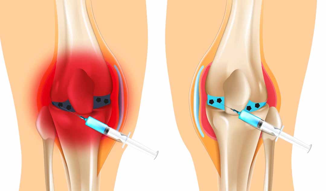 Dịch bao hoạt dịch giúp khớp của bạn như thế nào ?