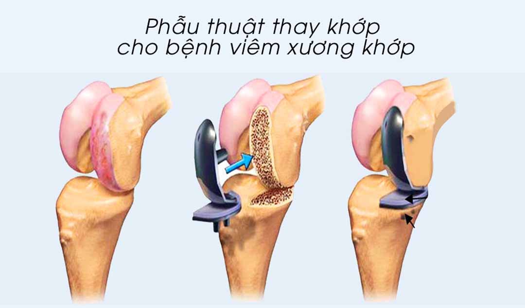 Làm sao để người bệnh nhận biết được đã đến lúc họ cần thực hiện phẫu thuật thay khớp cho bệnh viêm xương khớp?