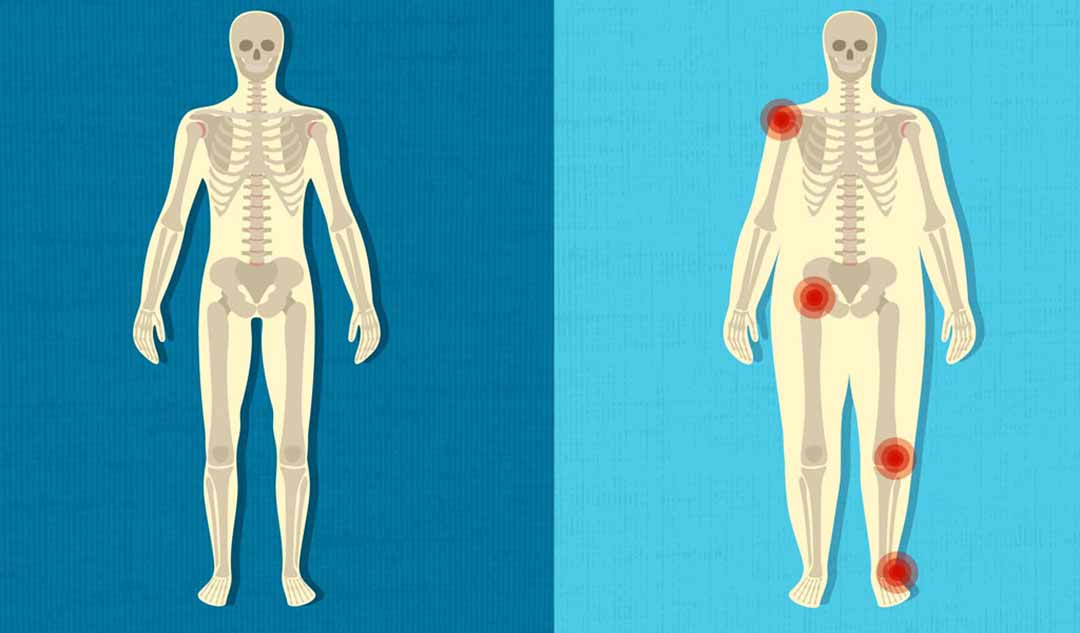 Nguyên nhân gây viêm xương khớp gối là gì ?