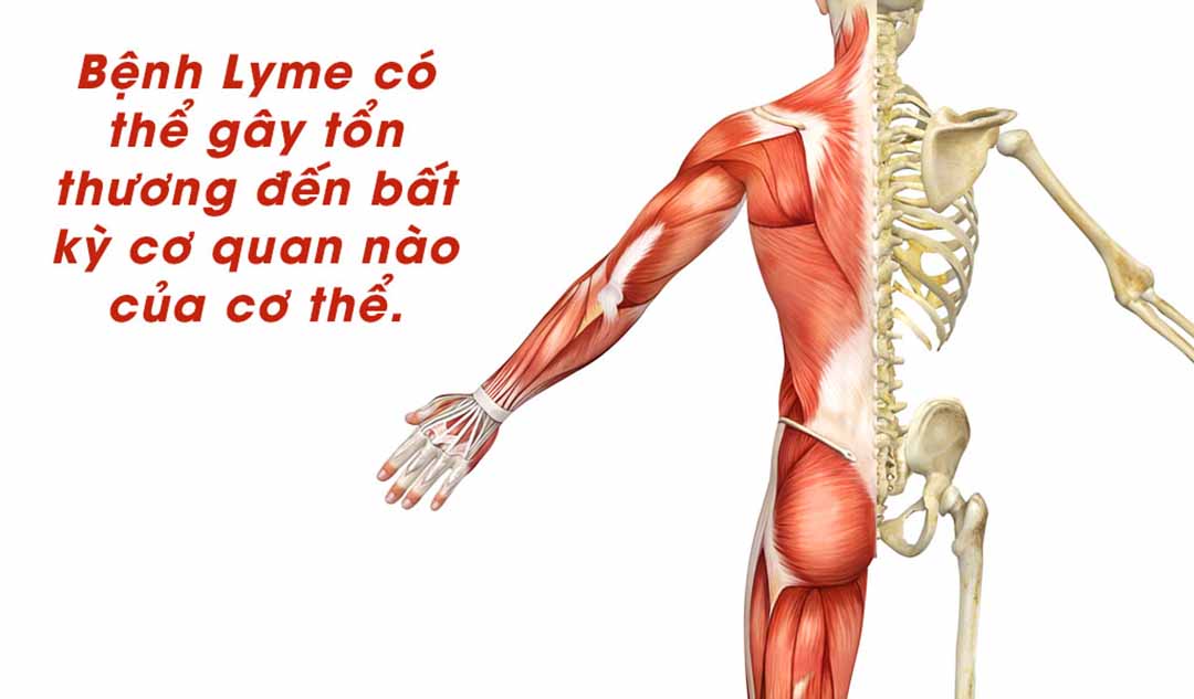 Những cơ quan nào có thể bị tổn thương bởi bệnh Lyme ?