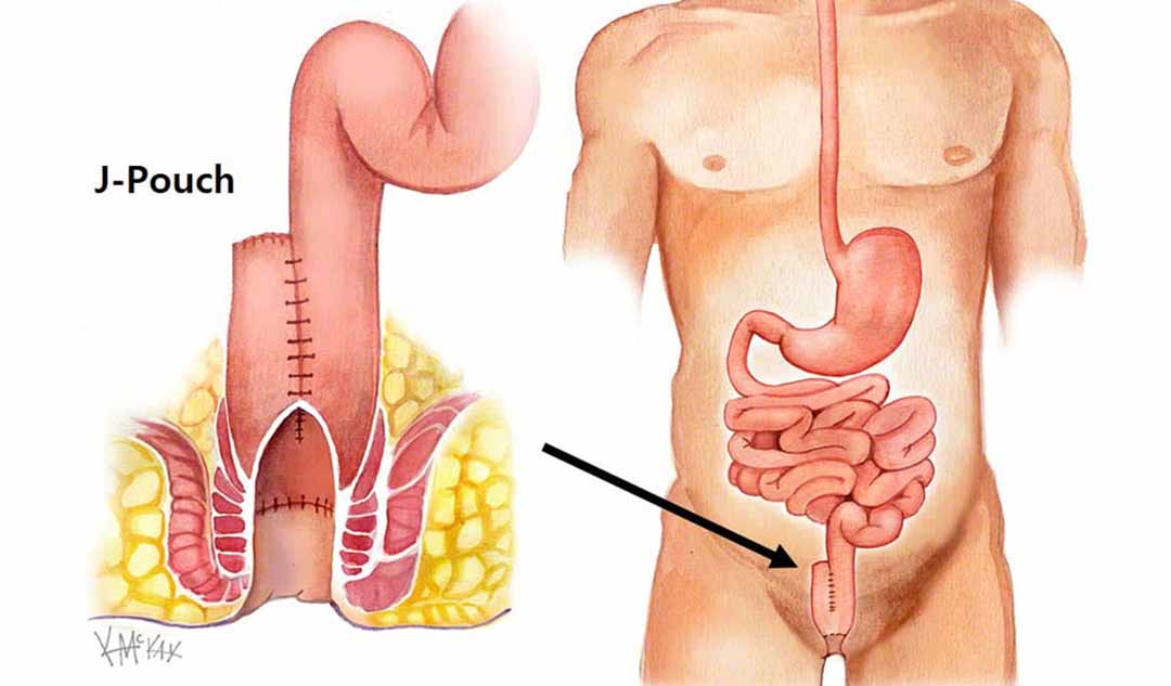 Sự viêm nhiễm xuất hiện ở vị trí nào khi bạn mắc bệnh Crohn và viêm loét đại tràng? 