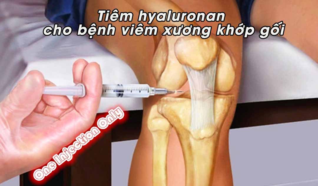 Tiêm hyaluronan cho bệnh viêm xương khớp gối là gì ?