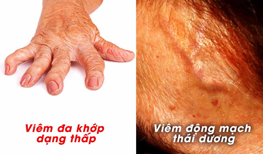 Tiên lượng lâu dài cho những người bị viêm đa khớp dạng thấp và viêm động mạch thái dương là gì ?