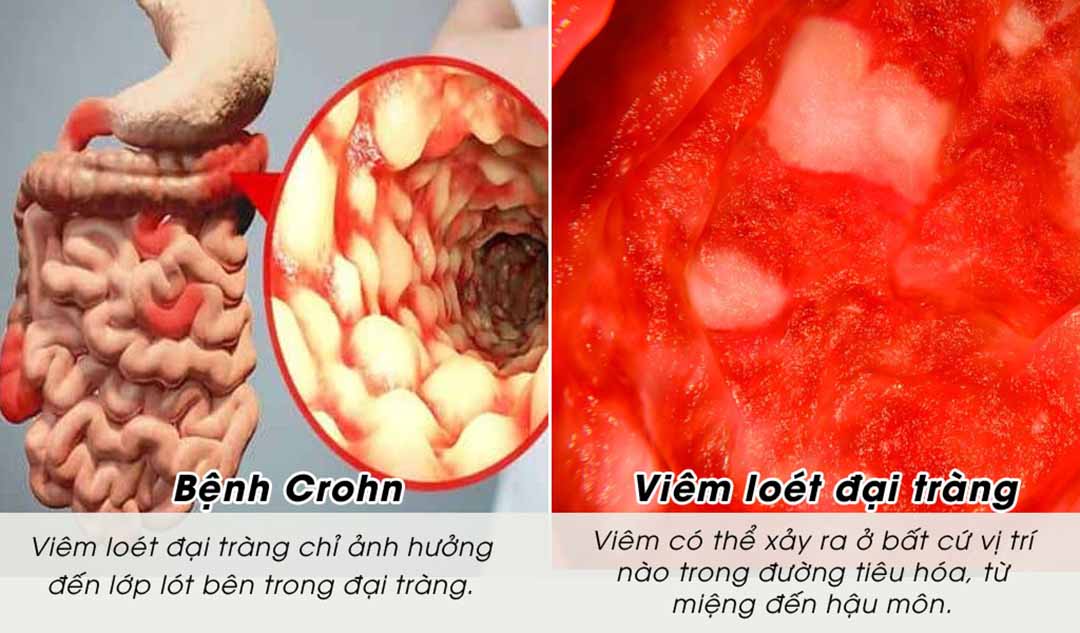 Vị trí bệnh của Crohn và viêm loét đại tràng (UC - Ulcerative Colitis) khác nhau như thế nào ?