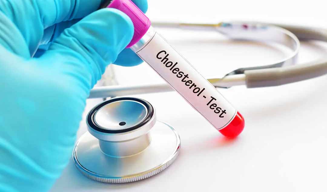 Bạn nên chuẩn bị như thế nào cho một xét nghiệm cholesterol?