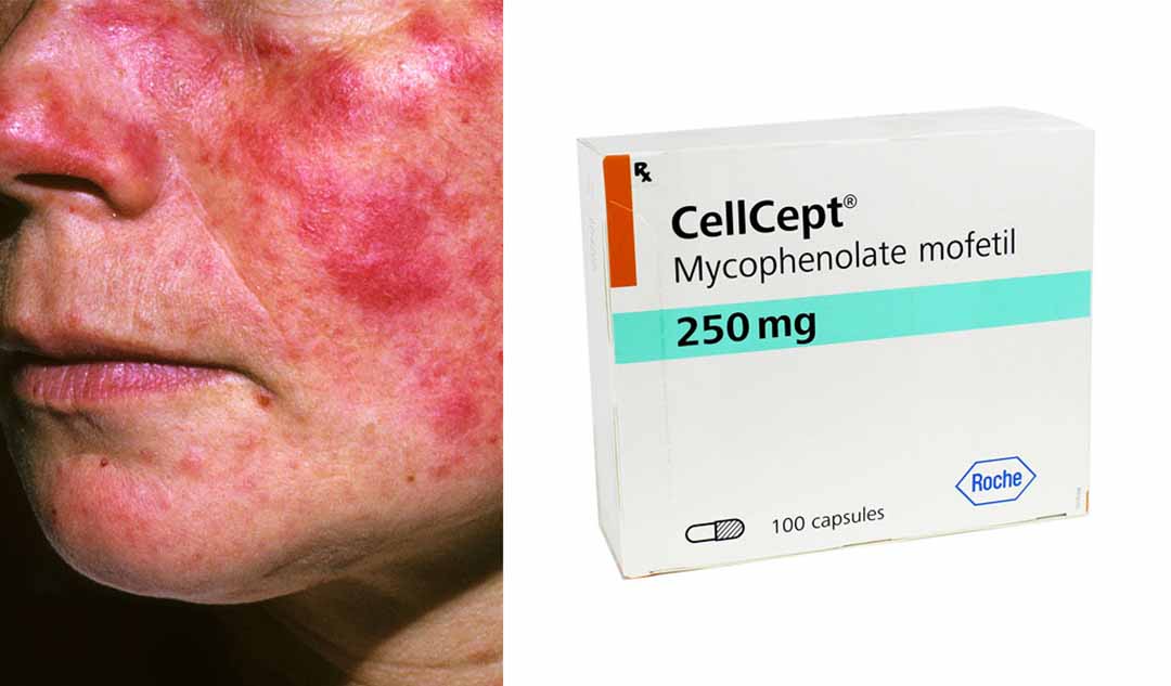 CellCept (mycophenolate mofetil) được sử dụng để điều trị bệnh lupus như thế nào?