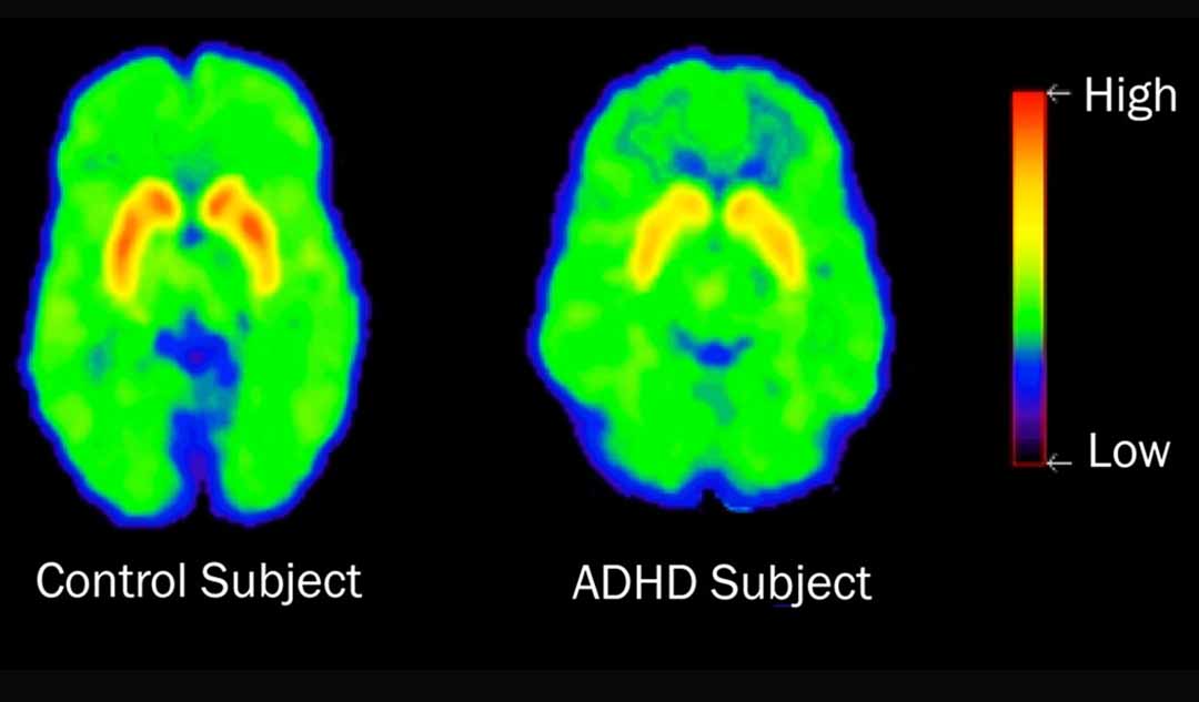  Điều gì diễn ra trong não của người bị ADHD?