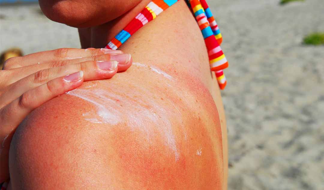 Làm thế nào ánh sáng mặt trời có thể ảnh hưởng đến bệnh lupus?