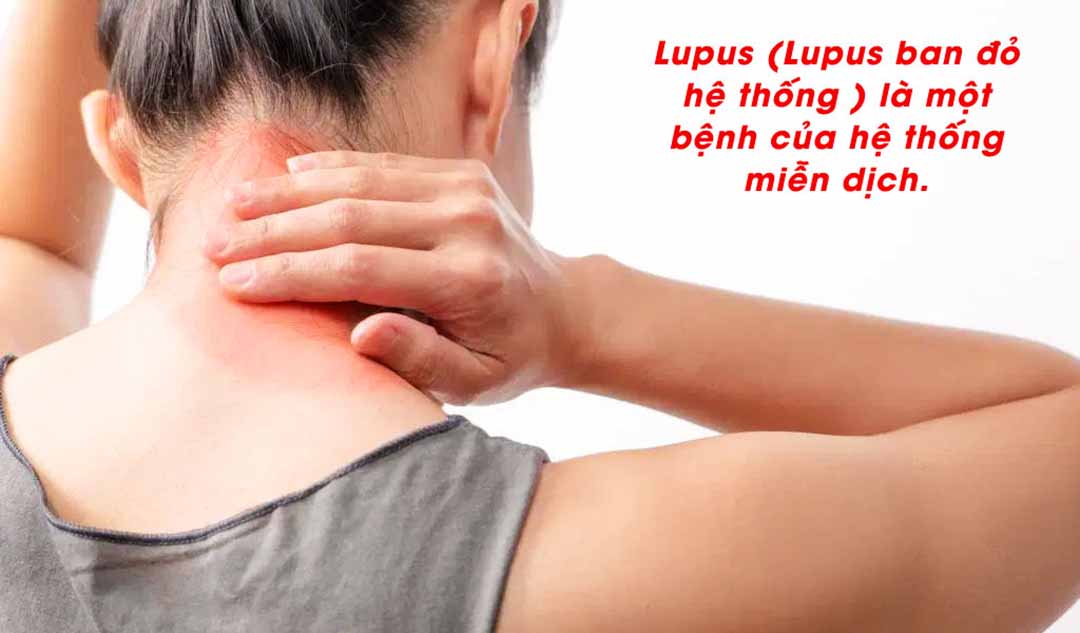 Lupus là gì?