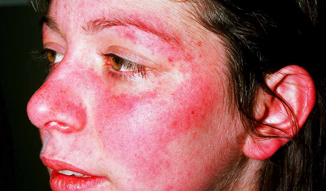 Người bị bệnh lupus nên tránh những thực phẩm nào?