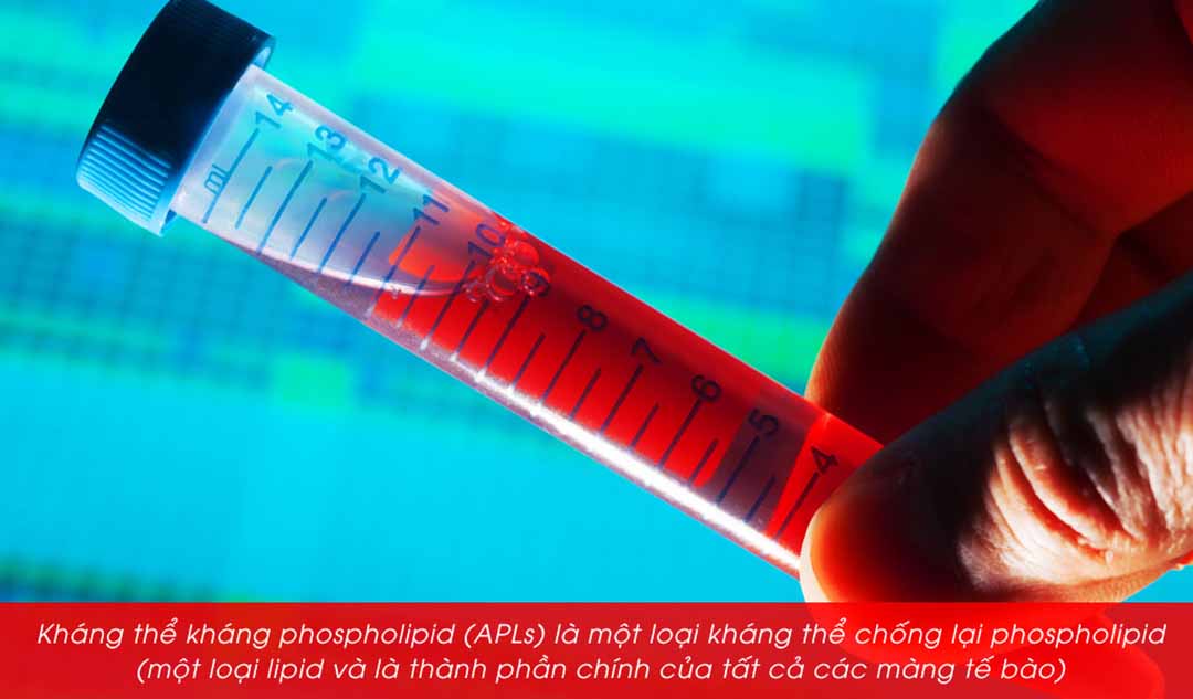 Những công dụng và hạn chế của xét nghiệm kháng thể antiphospholipid đối với bệnh lupus là gì?
