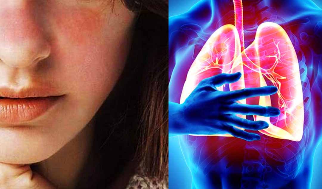 Những điều gì tôi có thể làm cho tim và phổi để giảm bớt ảnh hưởng từ bệnh lupus?