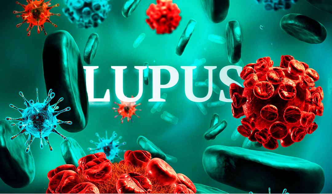 Những yếu tố nào có thể đóng góp vào sự phát triển của bệnh lupus?
