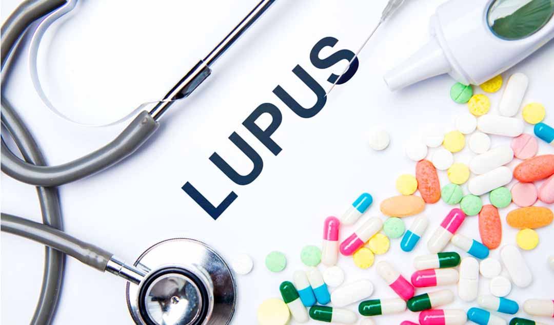 Steroid được sử dụng để điều trị lupus như thế nào?