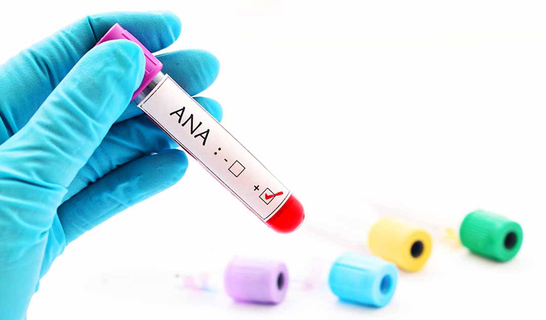 Xét nghiệm kháng thể kháng nhân cho bệnh lupus là gì?