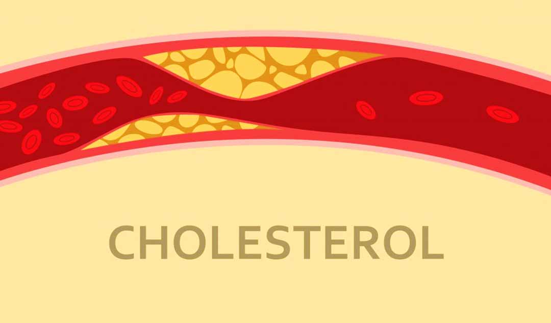 Apheresis LDL cho cholesterol là gì?