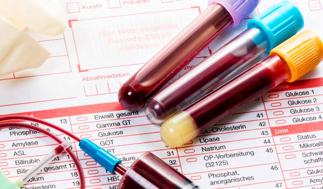 Bác sĩ có thể làm những xét nghiệm nào để giúp chẩn đoán tăng cholesterol máu gia đình đồng hợp tử?