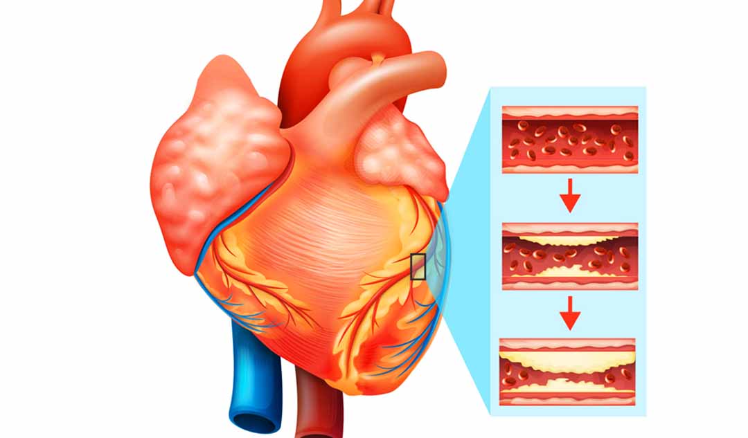 Cholesterol có liên quan gì đến bệnh tim mạch vành?