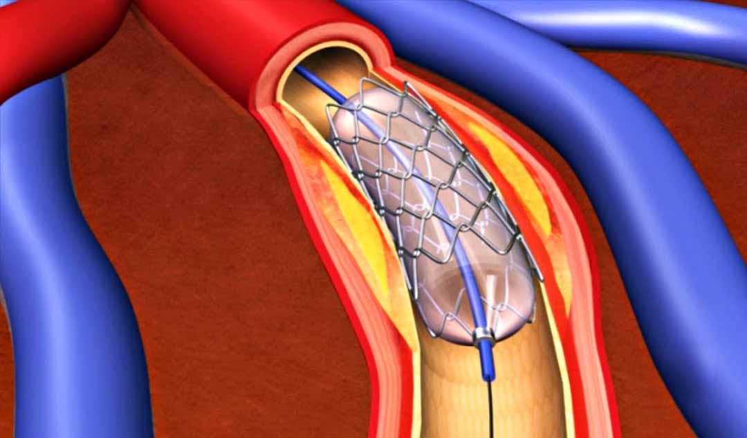 Chụp động mạch, nong mạch vành và đặt stent là gì và nó được sử dụng như thế nào để làm thông động mạch?