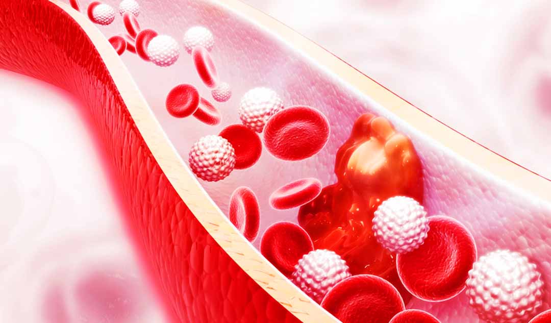 Dấu hiệu chính của tăng cholesterol máu gia đình đồng hợp tử là gì?