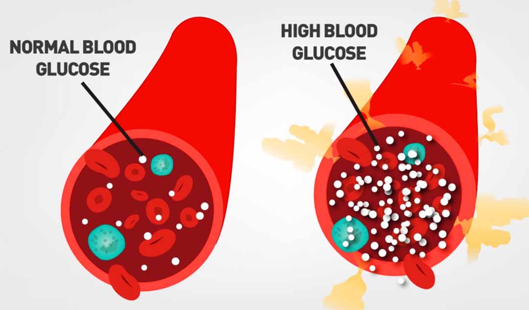 Làm thế nào bác sĩ có thể kiểm tra lượng đường trong máu cao?