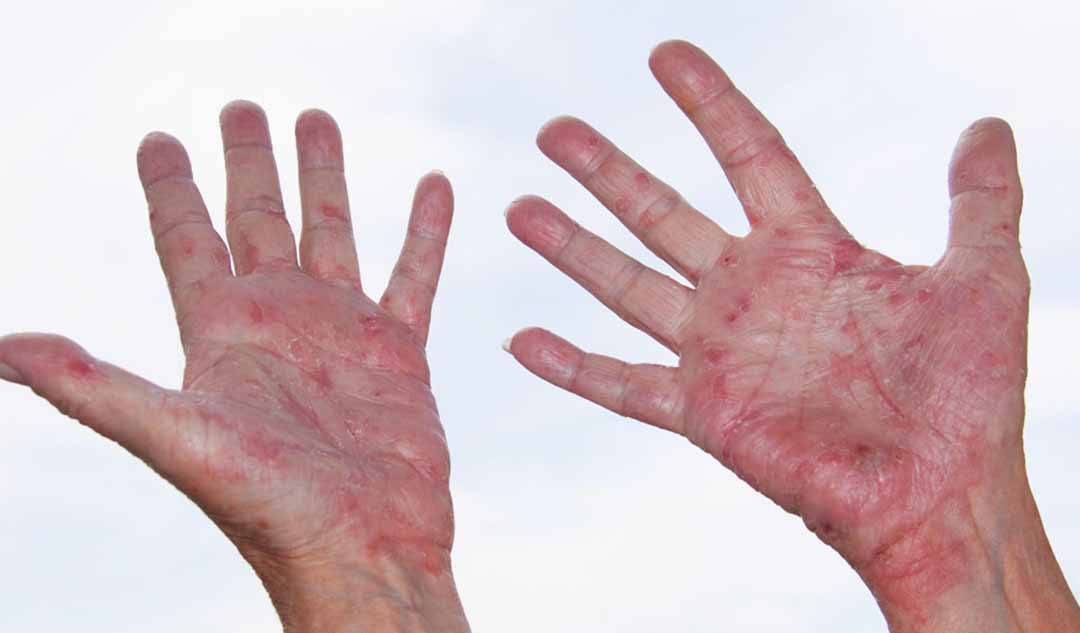 Làm thế nào để điều trị những đợt bùng phát bệnh chàm trên tay?