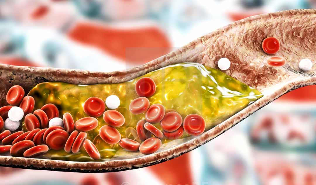 Làm thế nào mà mảng bám cholesterol gây ra bệnh động mạch ngoại biên?