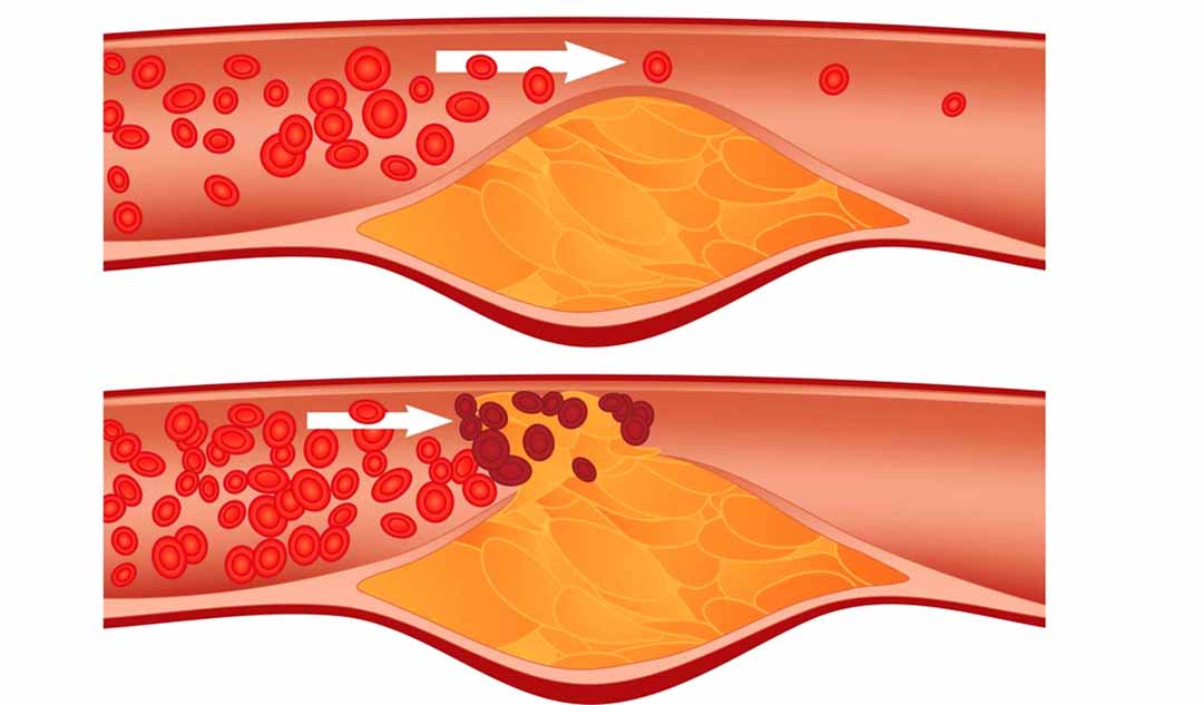 Mức cao giới hạn của cholesterol là gì?