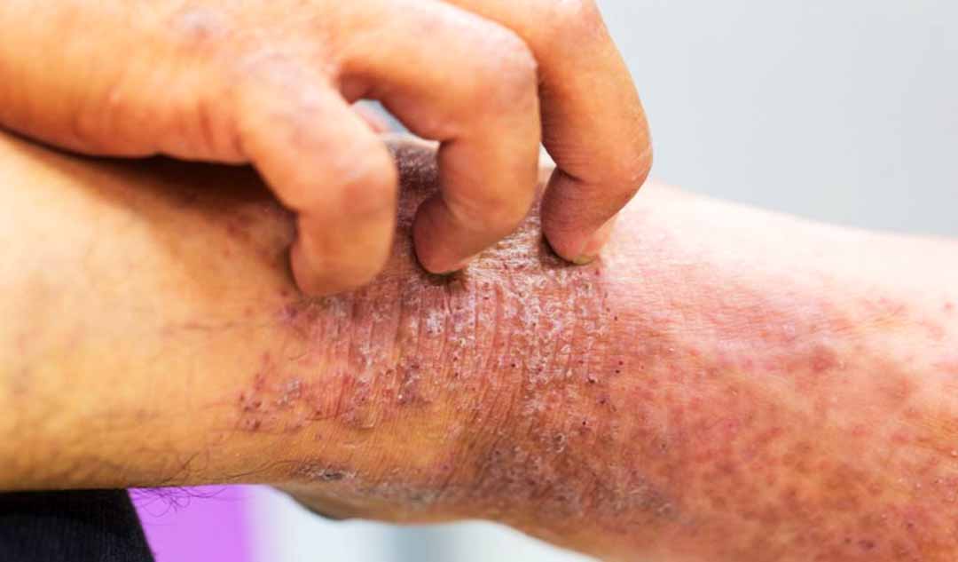 Có bao nhiêu người bị ảnh hưởng bởi bệnh chàm (Eczema)?