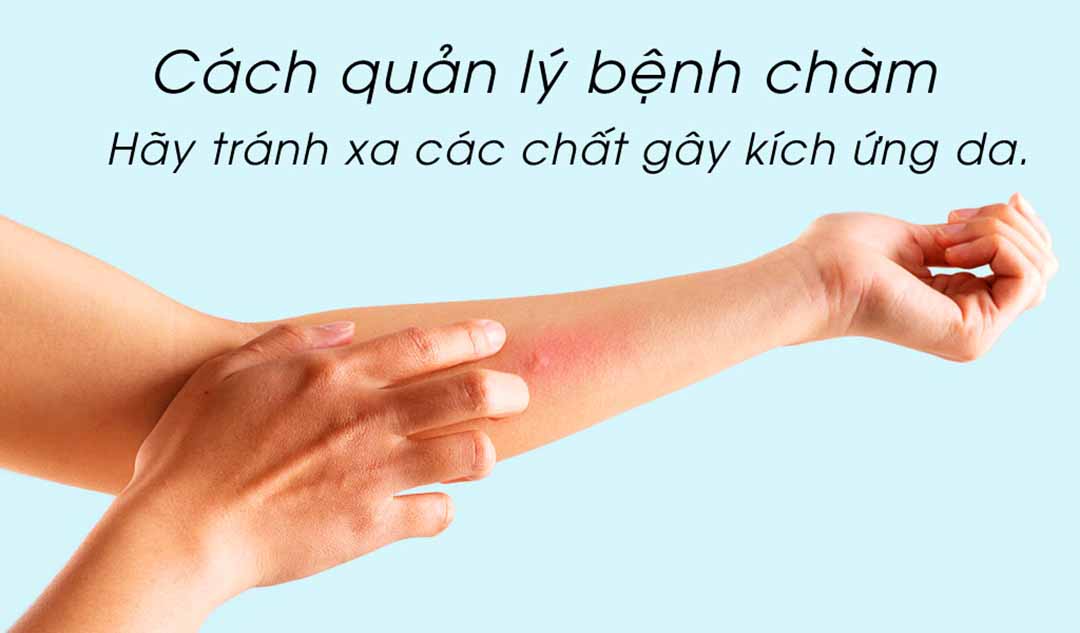 Làm thế nào bạn có thể quản lý bệnh chàm?